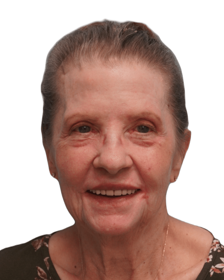 Envision Cosmetic Surgery chemical peel after — Murray, UT
