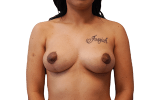Breast Lift after at Envision Cosmetic Surgery in Murray, UT