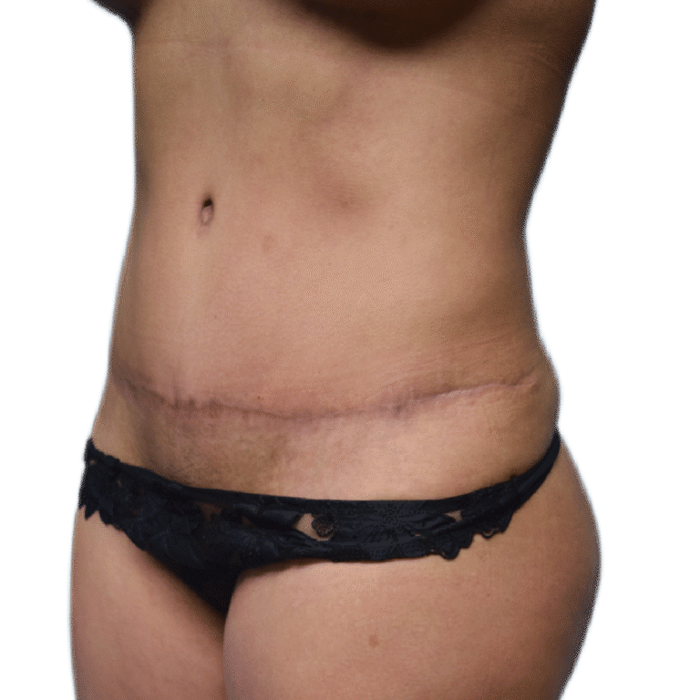 Envision Cosmetic Surgery liposuction after — Murray, UT