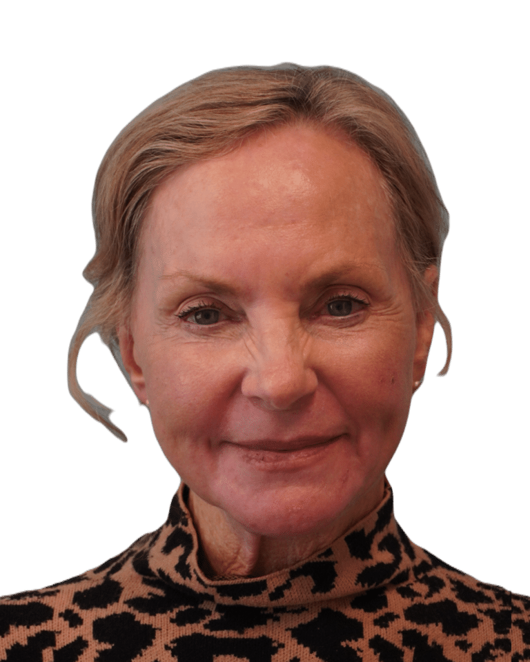Envision Cosmetic Surgery chemical peel after — Murray, UT
