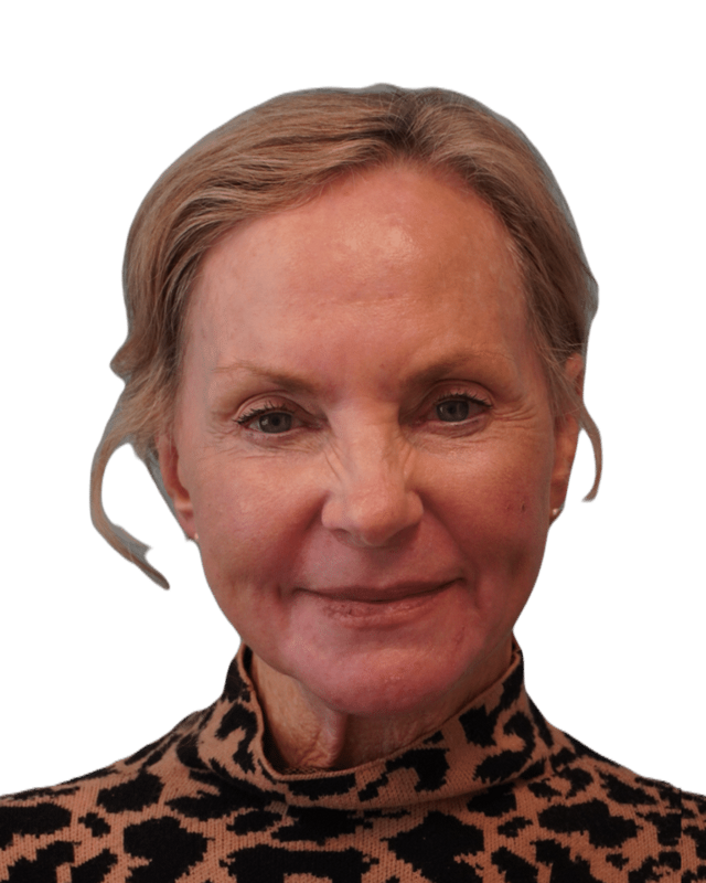 Chemical Peel after at Envision Cosmetic Surgery in Murray, UT