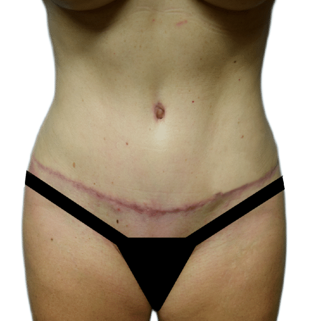 Tummy Tuck after at Envision Cosmetic Surgery in Murray, UT