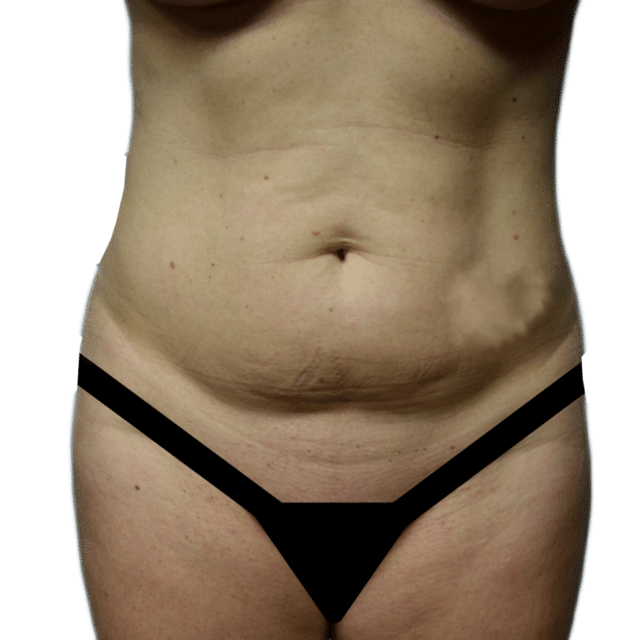Tummy Tuck before at Envision Cosmetic Surgery in Murray, UT