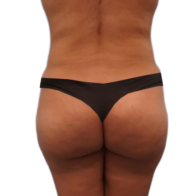 Brazilian Butt Lift before at Envision Cosmetic Surgery in Murray, UT