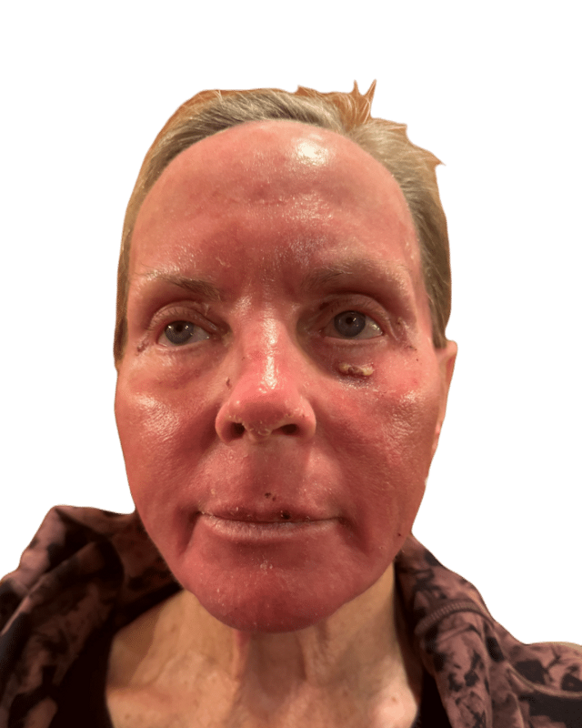 Chemical Peel after at Envision Cosmetic Surgery in Murray, UT