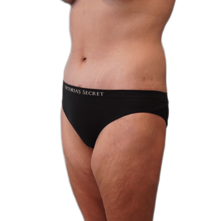 Envision Cosmetic Surgery body lift after — Murray, UT