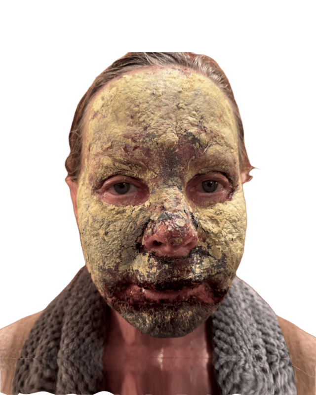 Chemical Peel before at Envision Cosmetic Surgery in Murray, UT