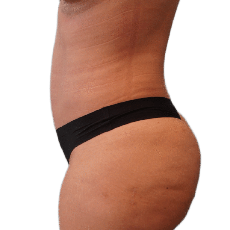 Envision Cosmetic Surgery liposuction after — Murray, UT