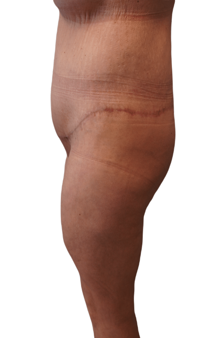 Envision Cosmetic Surgery body lift after — Murray, UT