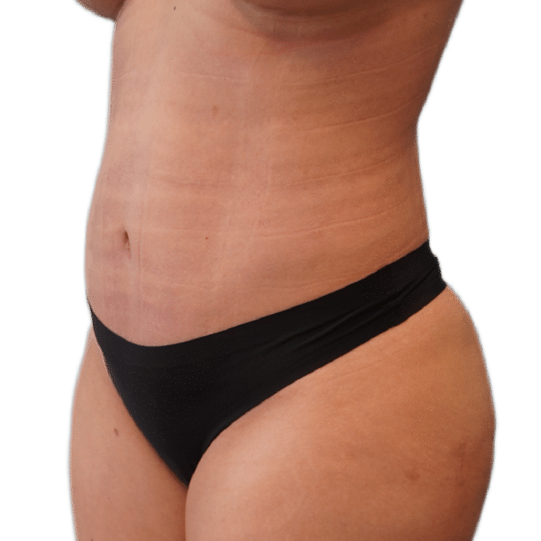 Envision Cosmetic Surgery liposuction after — Murray, UT