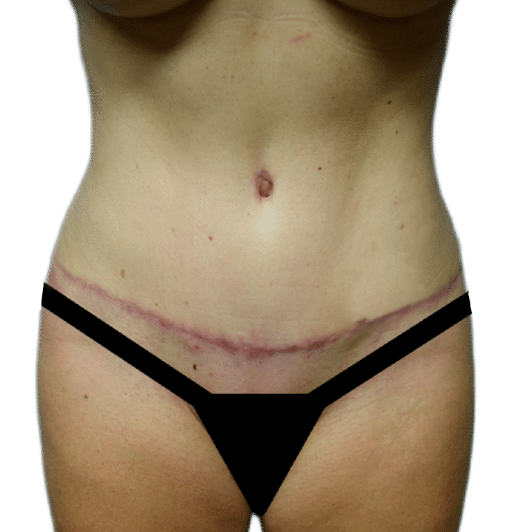 Envision Cosmetic Surgery liposuction after — Murray, UT