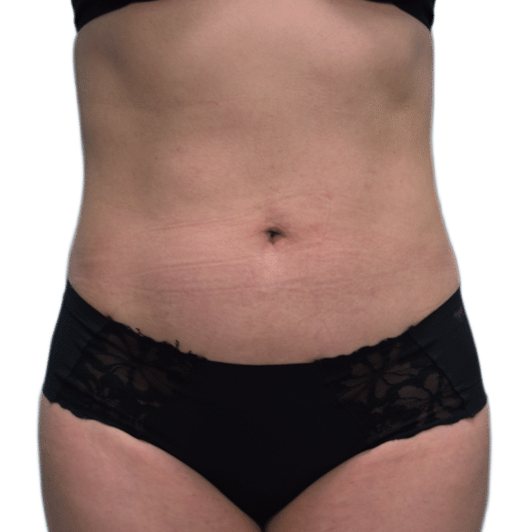 Envision Cosmetic Surgery liposuction after — Murray, UT