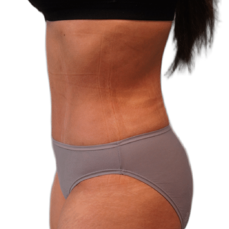 Envision Cosmetic Surgery liposuction after — Murray, UT