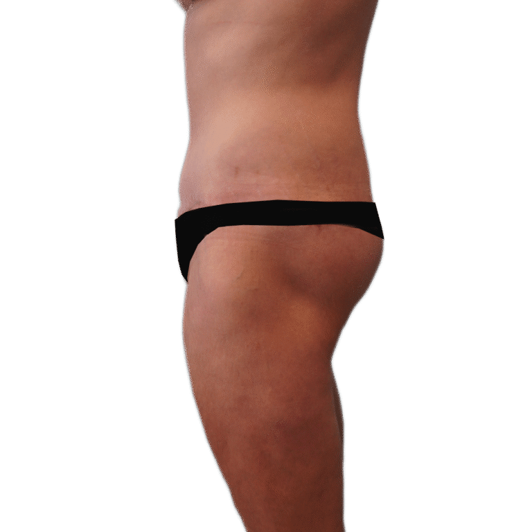 Envision Cosmetic Surgery body lift after — Murray, UT