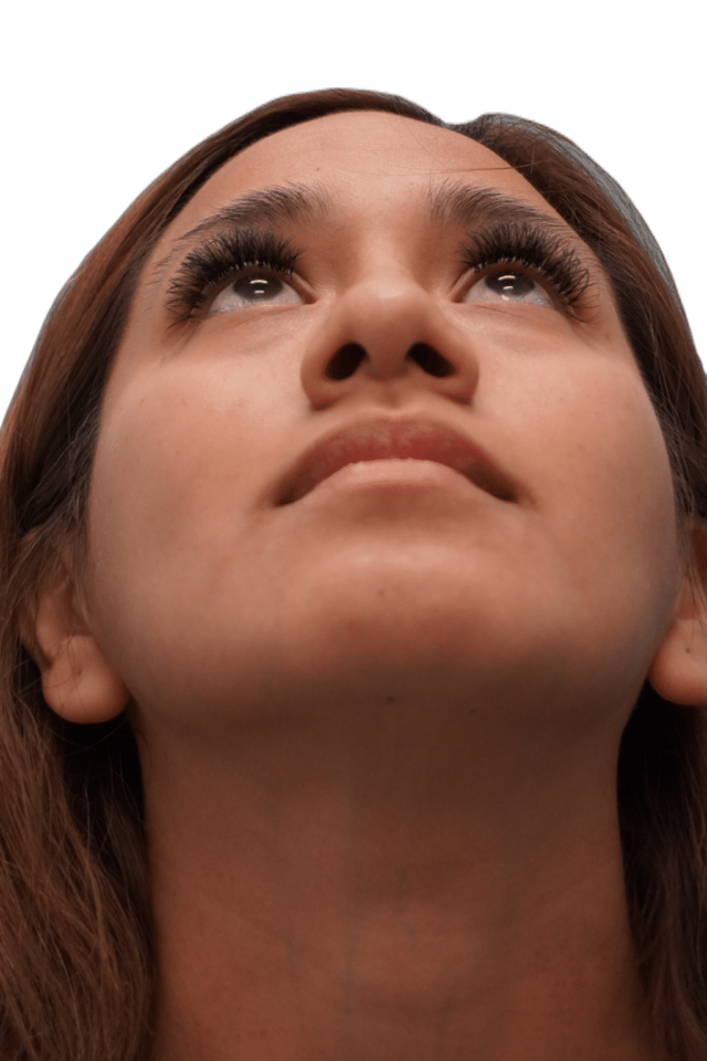 Rhinoplasty after at Envision Cosmetic Surgery in Murray, UT