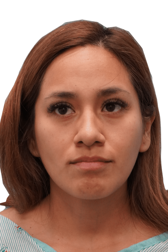 Rhinoplasty before at Envision Cosmetic Surgery in Murray, UT