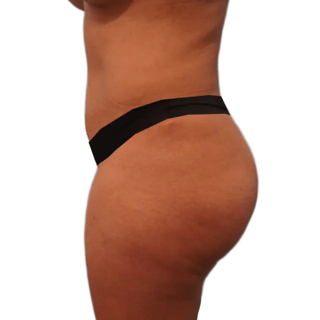 Brazilian Butt Lift before at Envision Cosmetic Surgery in Murray, UT
