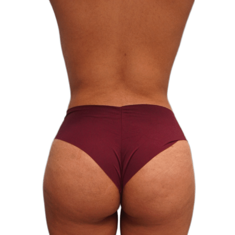 Envision Cosmetic Surgery bbl after — Murray, UT