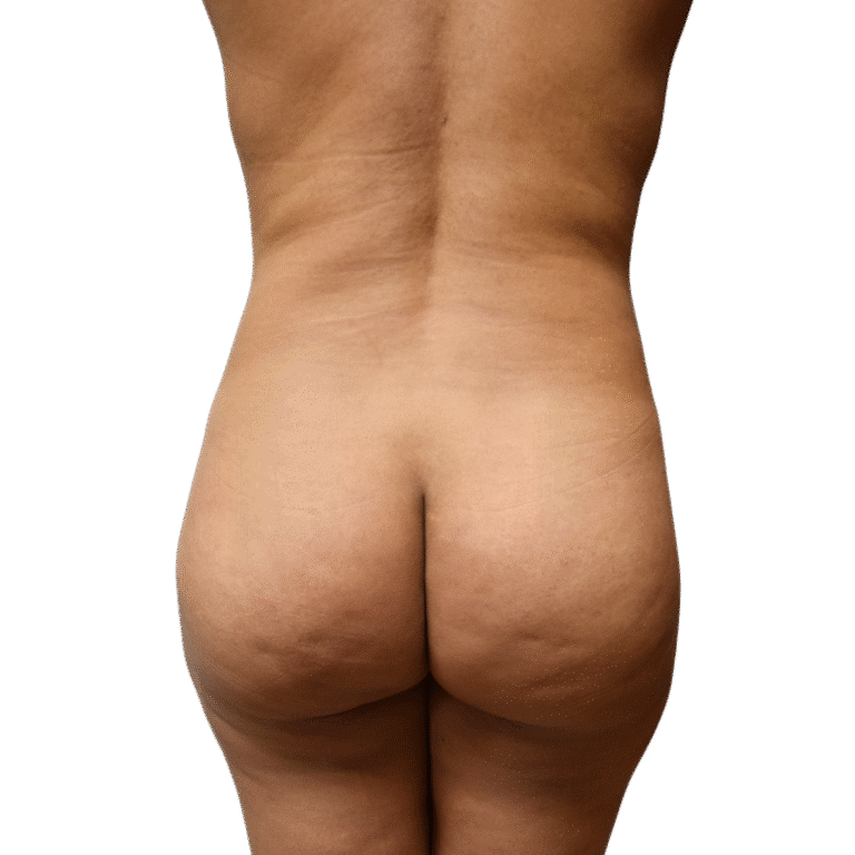 Envision Cosmetic Surgery bbl after — Murray, UT
