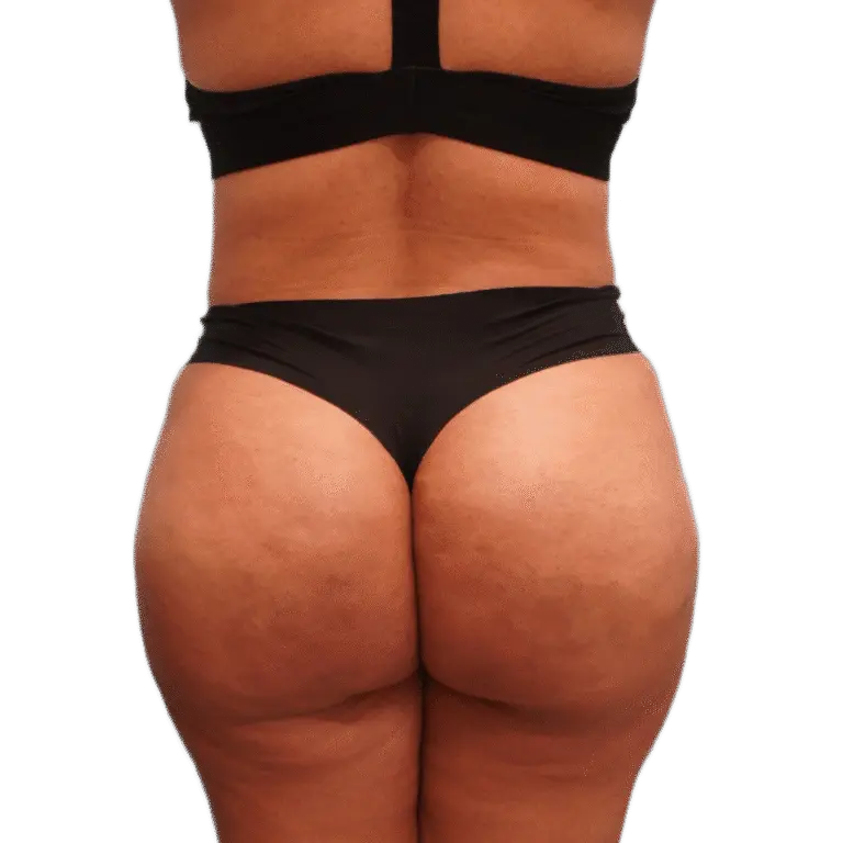 Envision Cosmetic Surgery liposuction after — Murray, UT