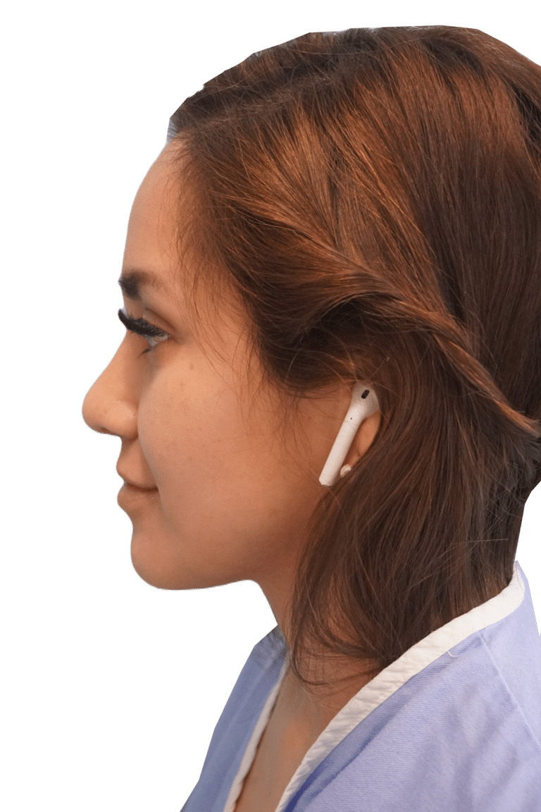 Envision Cosmetic Surgery rhinoplasty after — Murray, UT