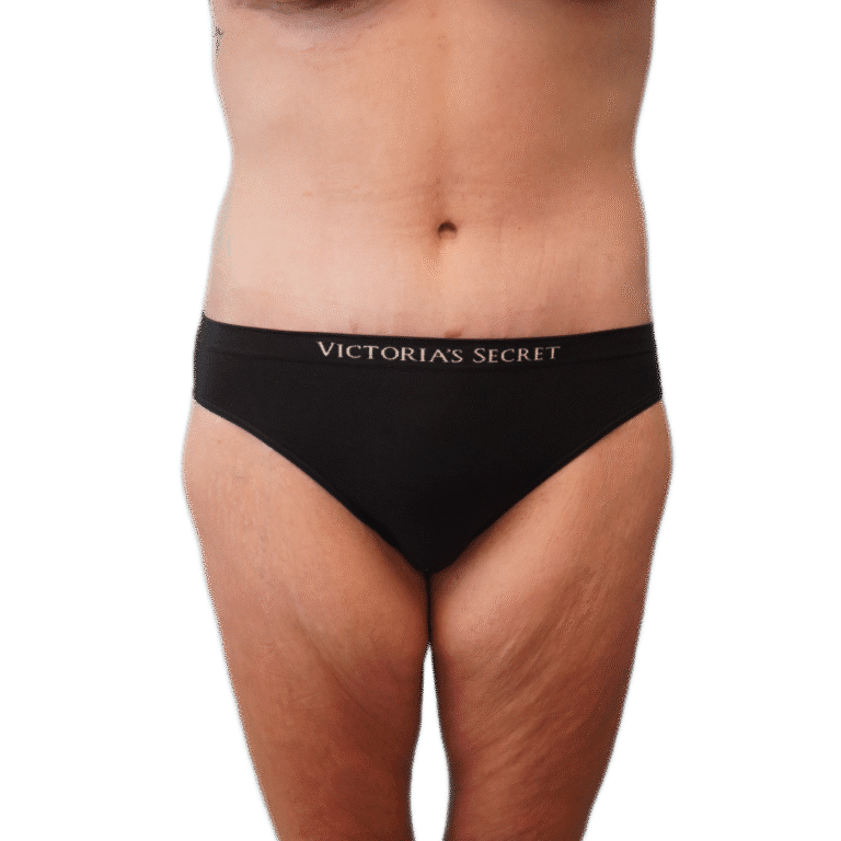 Envision Cosmetic Surgery body lift after — Murray, UT