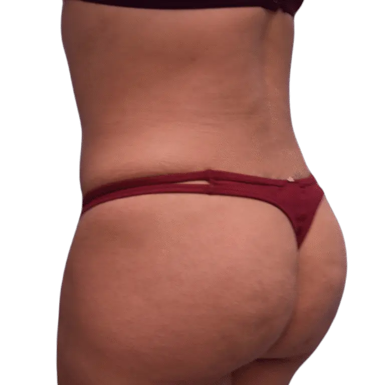Envision Cosmetic Surgery bbl after — Murray, UT