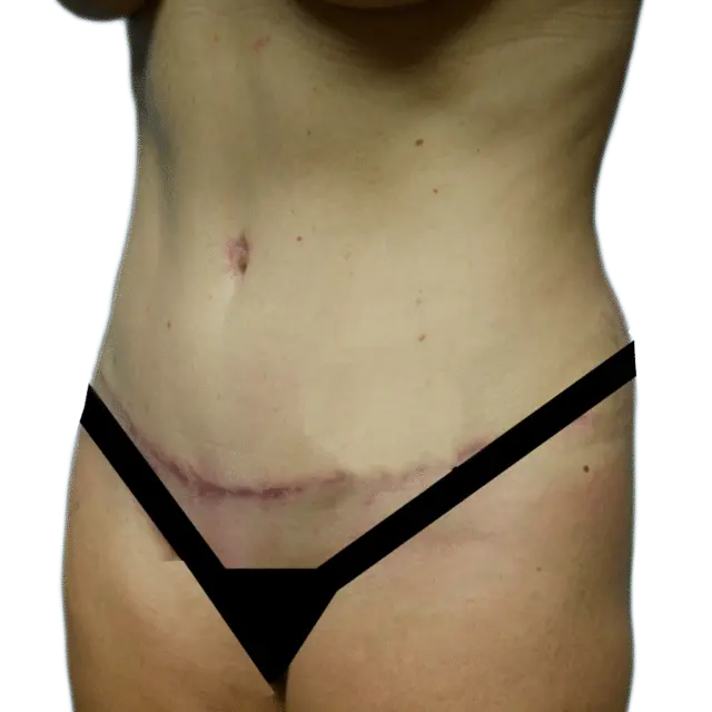 Mini Tummy Tuck after at Envision Cosmetic Surgery in Murray, UT
