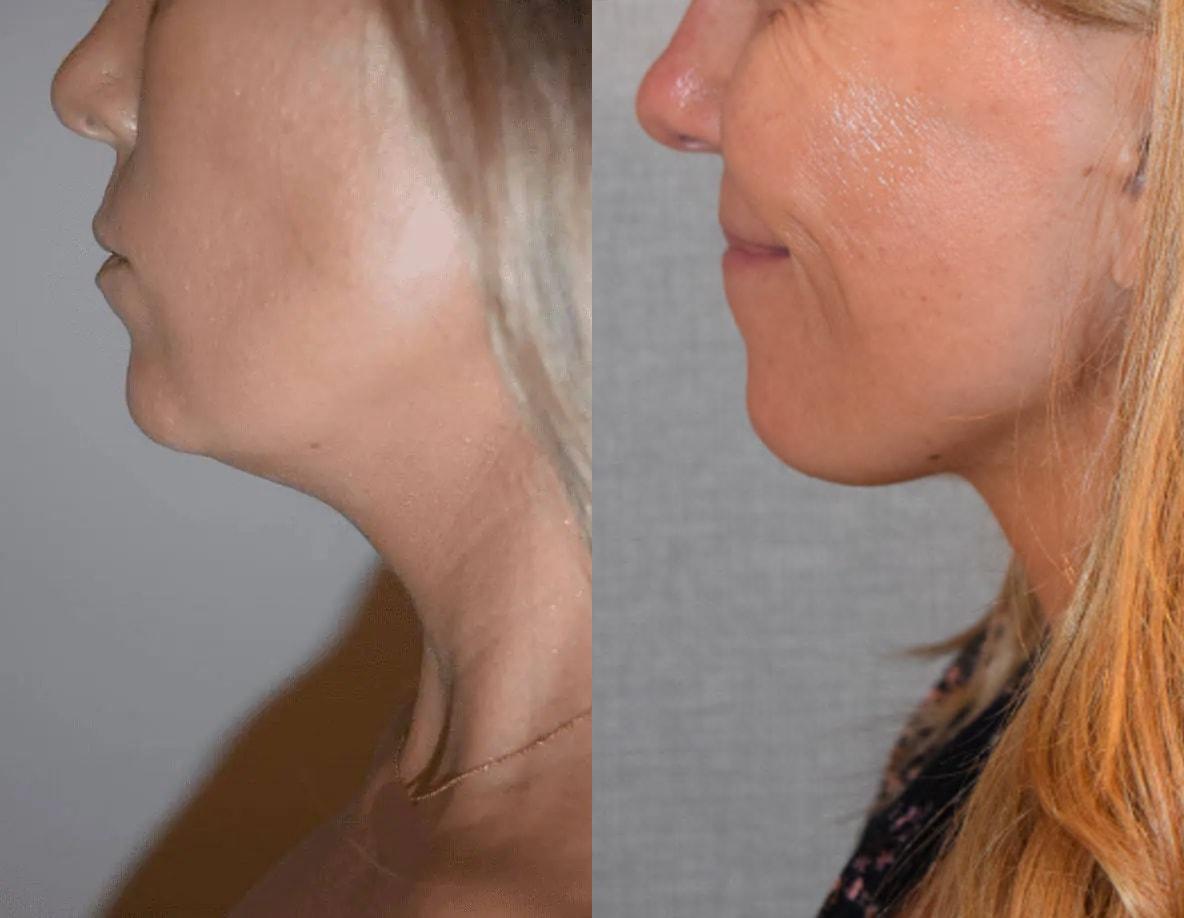 Darren M. Smith, MD, FACS neck liposuction result — New York, NY