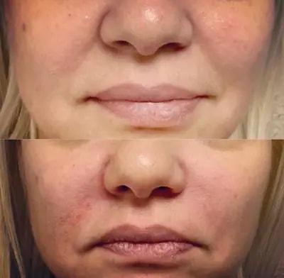 Darren M. Smith, MD, FACS lip filler result — New York, NY