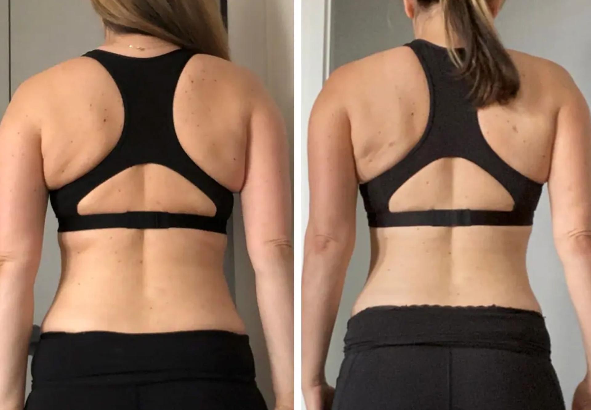 Darren M. Smith, MD, FACS liposuction result — New York, NY