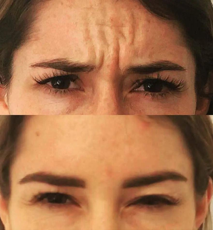 Darren M. Smith, MD, FACS botox result — New York, NY