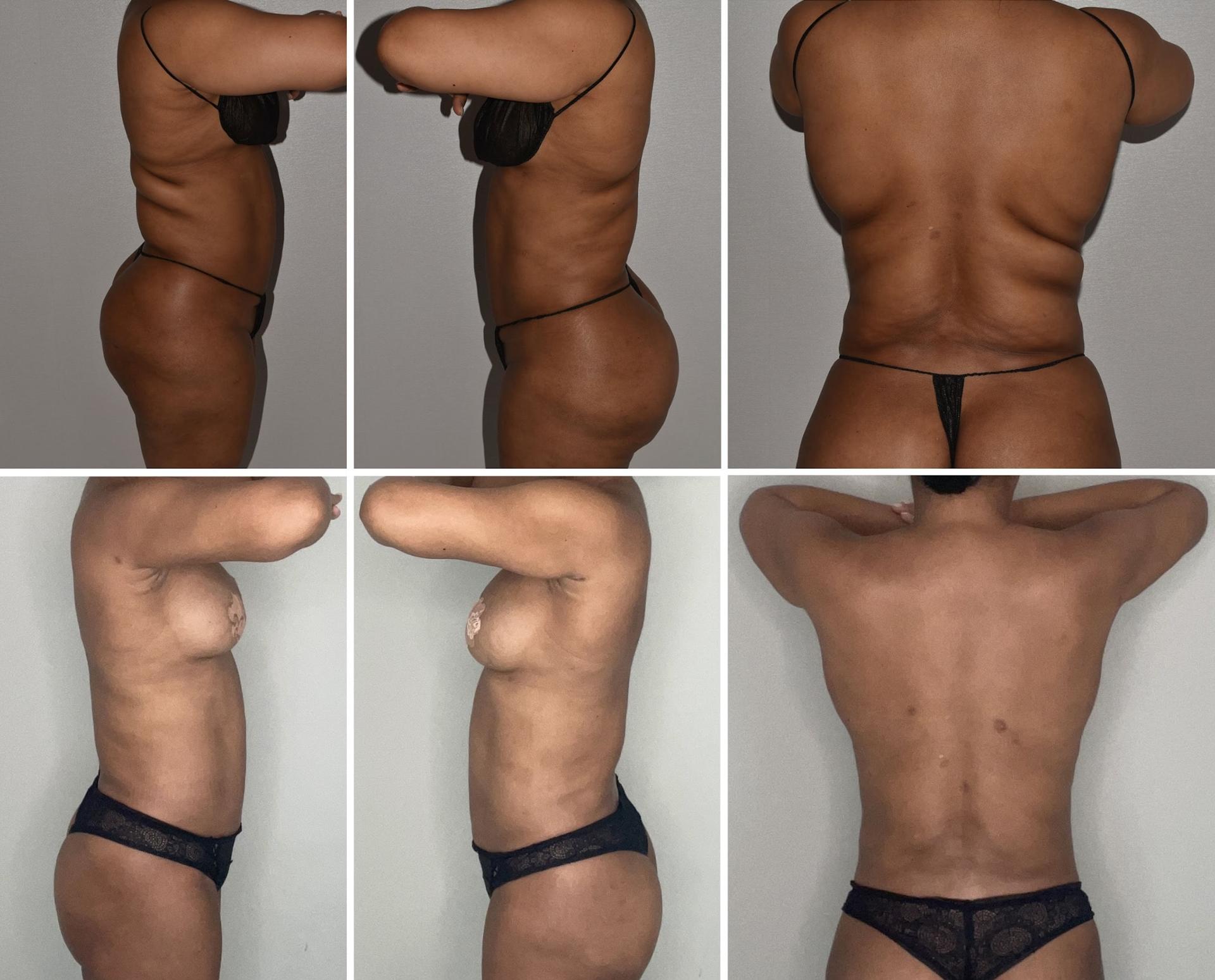 Darren M. Smith, MD, FACS liposuction result — New York, NY