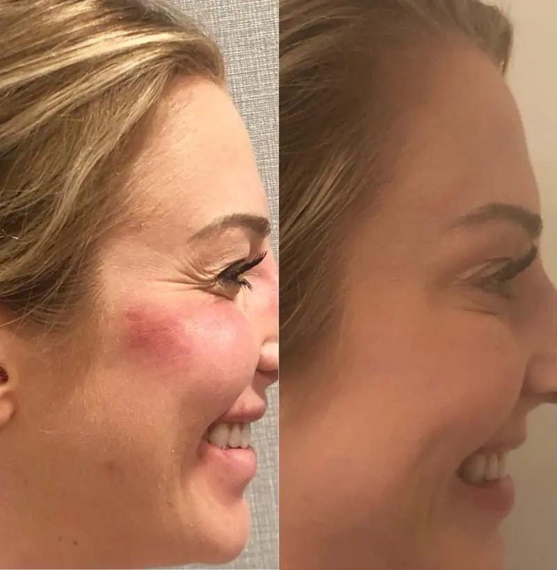 Darren M. Smith, MD, FACS botox result — New York, NY