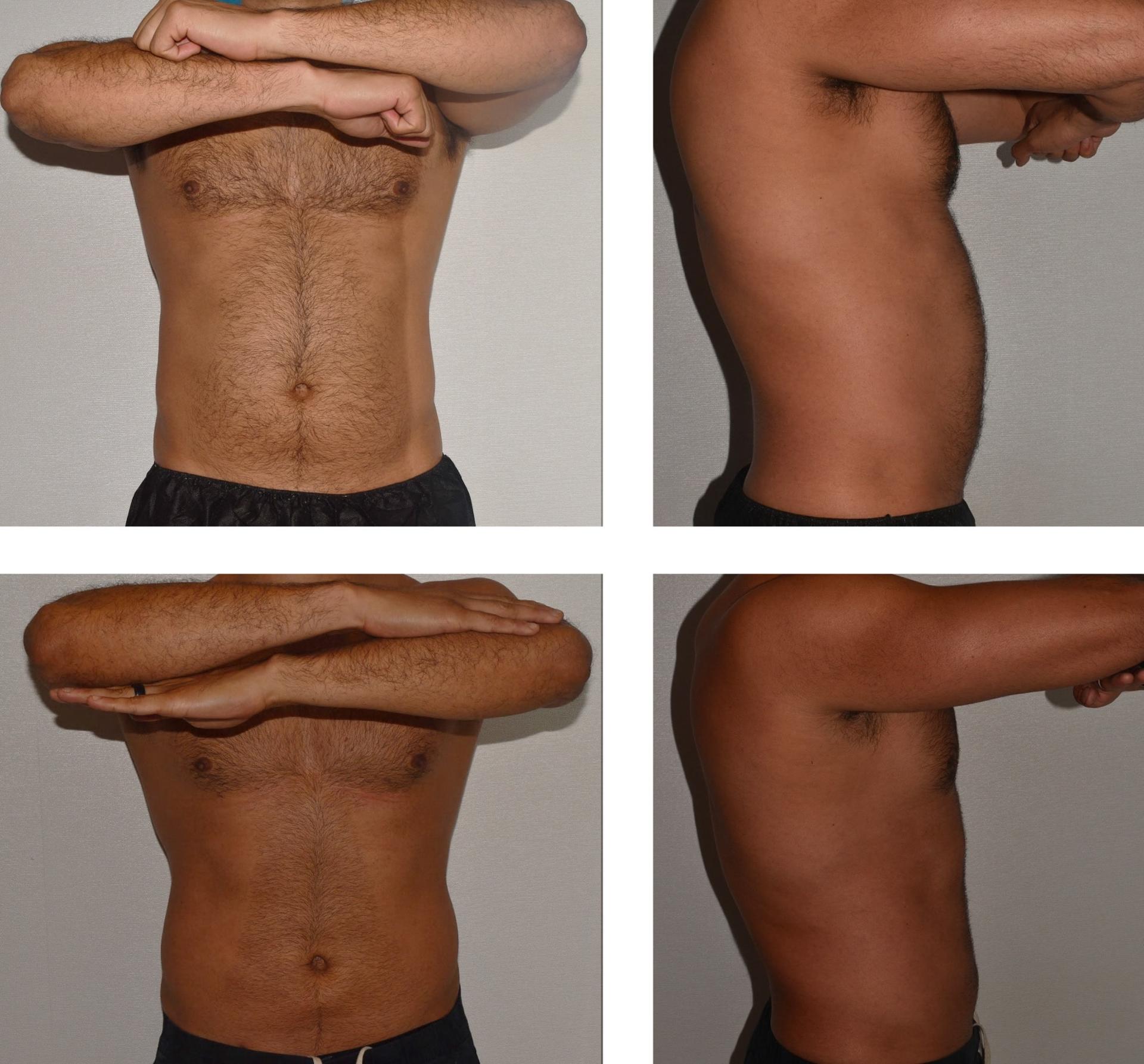 Darren M. Smith, MD, FACS liposuction result — New York, NY