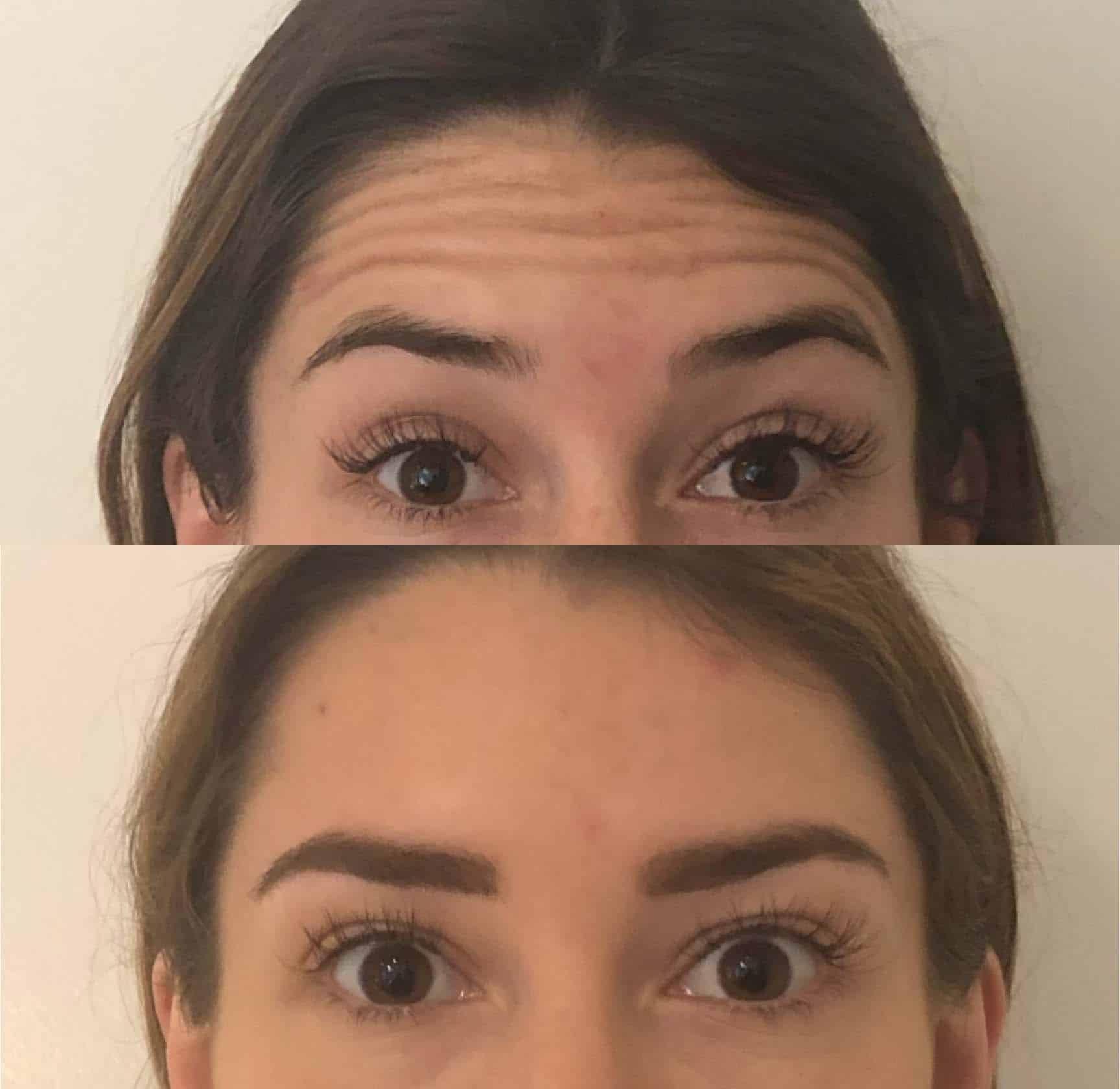 Darren M. Smith, MD, FACS botox result — New York, NY