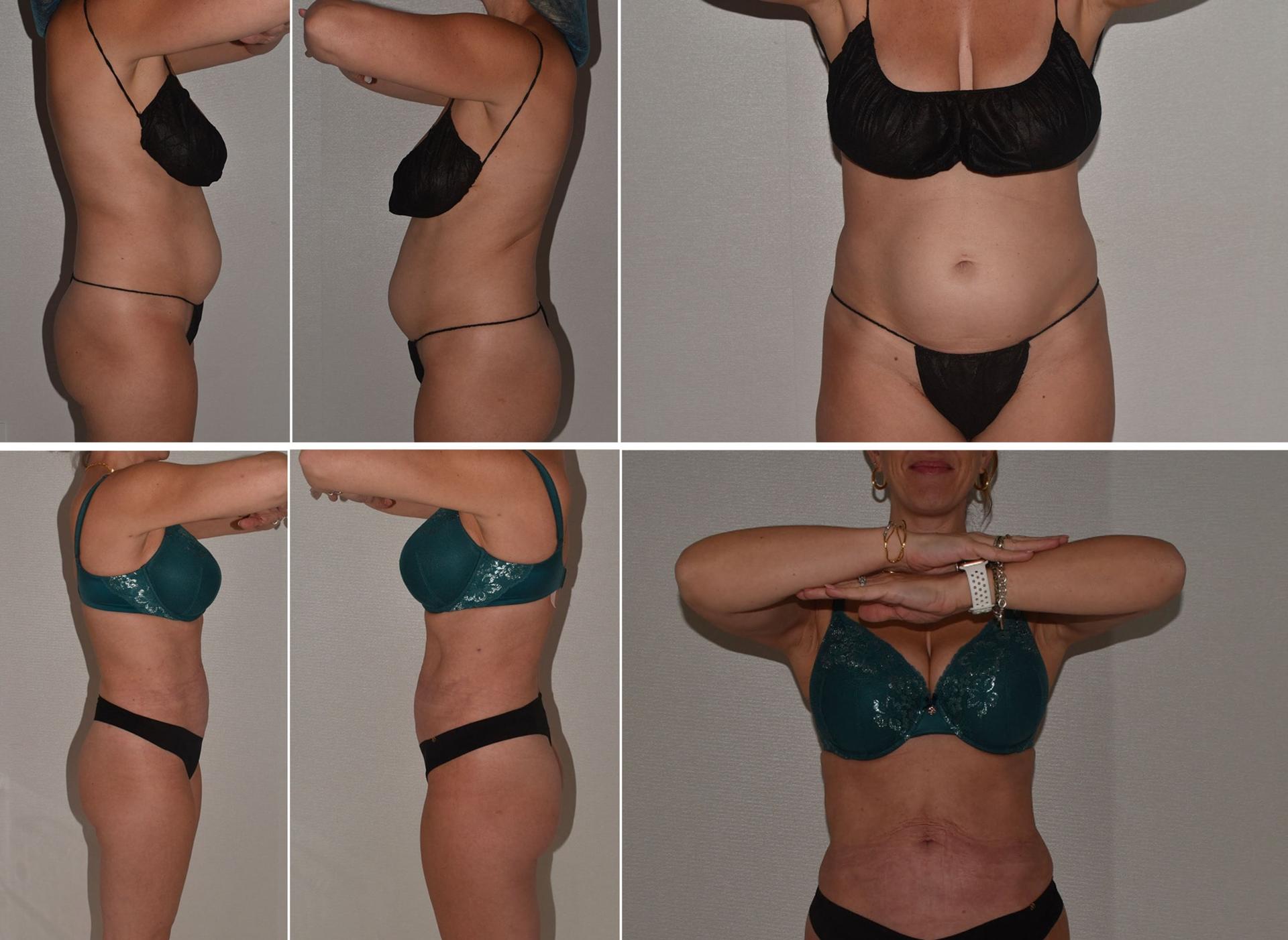 Darren M. Smith, MD, FACS liposuction result — New York, NY