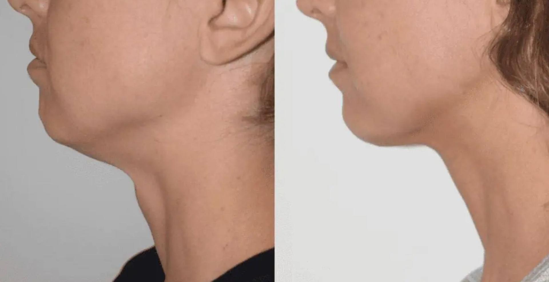Darren M. Smith, MD, FACS neck liposuction result — New York, NY