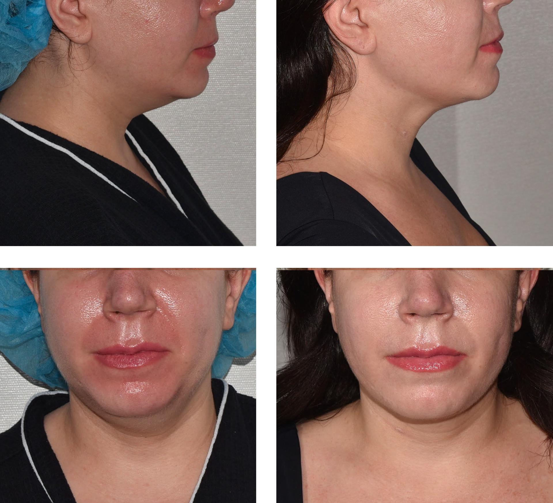 Darren M. Smith, MD, FACS neck liposuction result — New York, NY