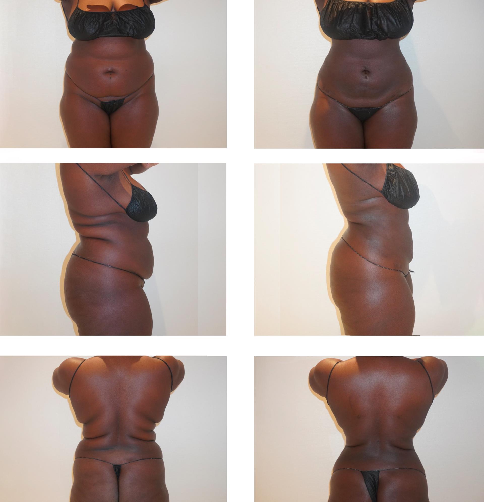 Darren M. Smith, MD, FACS liposuction result — New York, NY