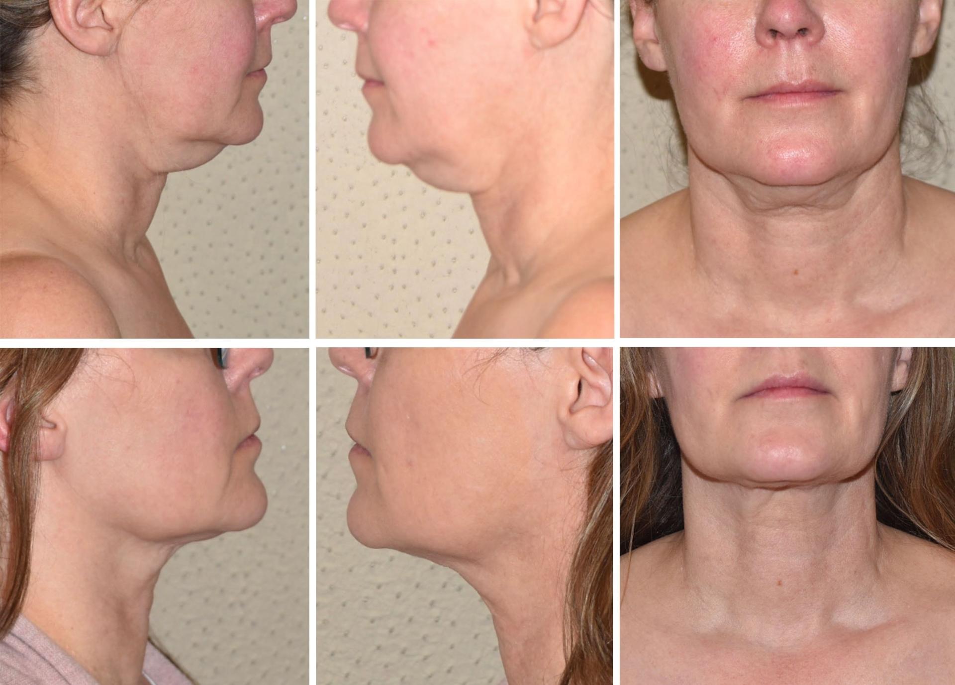 Darren M. Smith, MD, FACS neck liposuction result — New York, NY