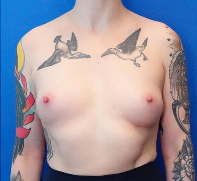 Breast Augmentation before at Said Plastic Surgery in Seattle, WA