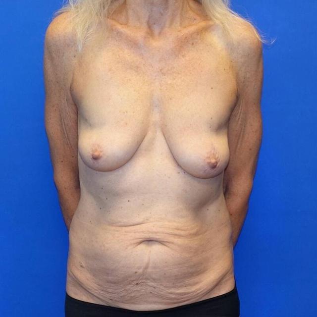 Mommy Makeover before at Said Plastic Surgery in Seattle, WA