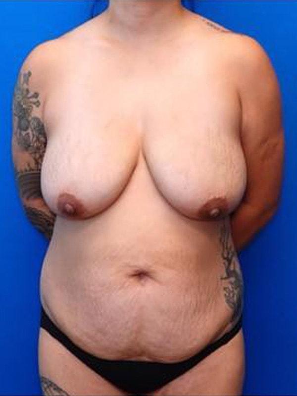 Mommy Makeover before at Said Plastic Surgery in Seattle, WA