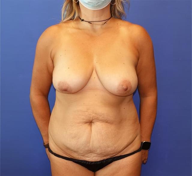 Mommy Makeover before at Said Plastic Surgery in Seattle, WA