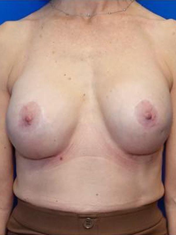 Said Plastic Surgery breast augmentation revision after — Seattle, WA
