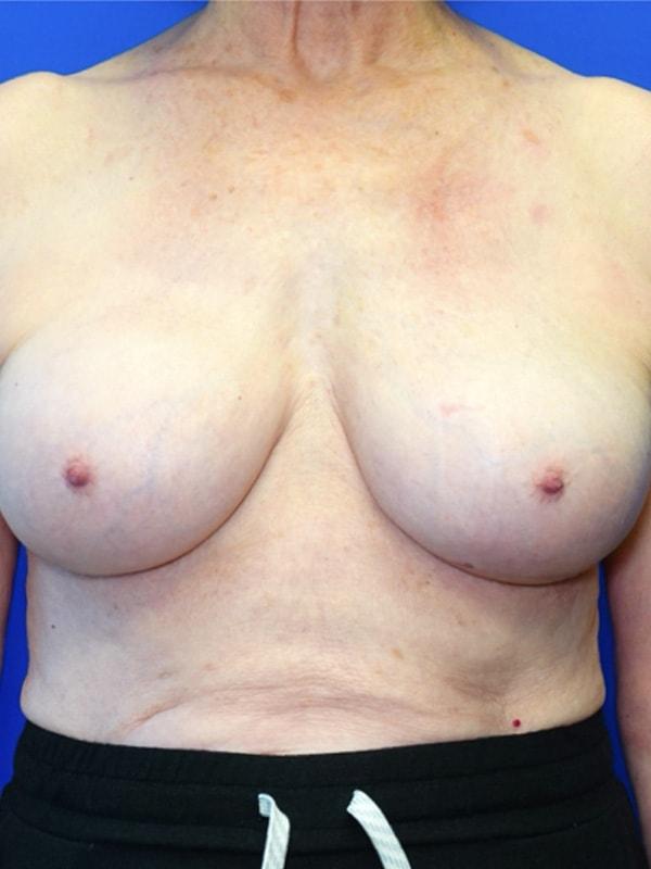 Said Plastic Surgery breast augmentation revision after — Seattle, WA