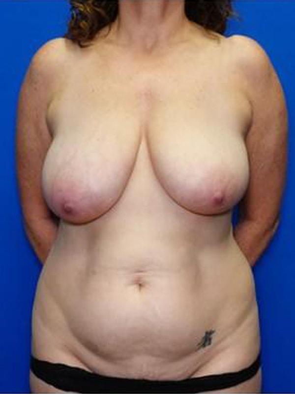 Mommy Makeover before at Said Plastic Surgery in Seattle, WA