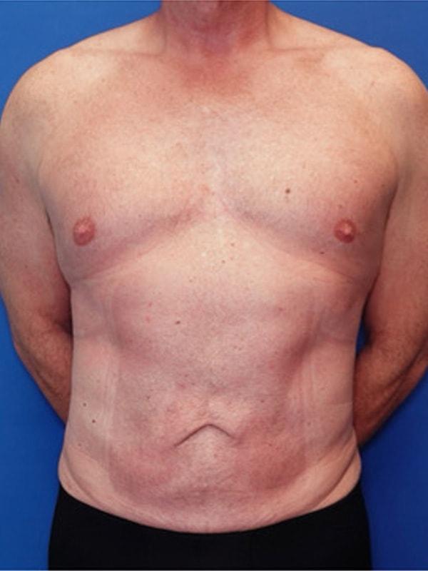 Liposuction after at Said Plastic Surgery in Seattle, WA