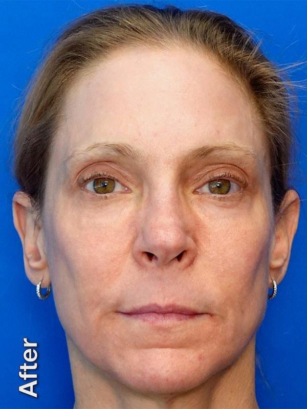 Said Plastic Surgery chemical peel after — Seattle, WA